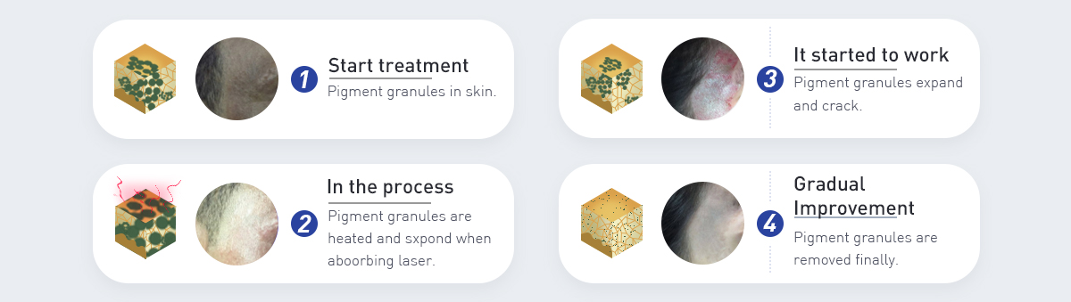 q kytketty Nd Yag Laser -kone